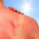 Oprez! Dermatolozi upozoravaju: Trovanje suncem je moguće – prepoznajte prvi simptom na vreme
